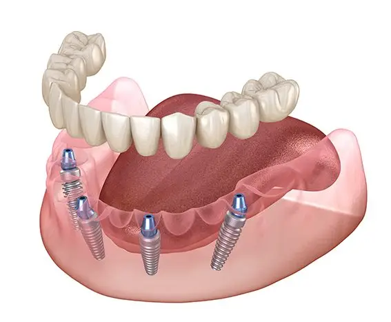 Implantatgetragener Zahnersatz: Versorgung gänzlich zahnloser Kieferreihen mit einer Brücke auf vier bis sechs Implantaten:
