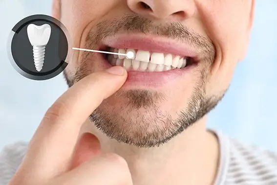 Ist ein Zahnimplantat bei einem einzelnen fehlenden Zahn empfehlenswert?
Natürlich können wir auch einen einzelnen fehlenden Zahn ersetzen. Hier ein Beispiel (siehe Video). Dieser Patient in seinen 50ern verliert einen einzigen Zahn. Er hat sehr gut gepflegte Zähne. Leider hat ein Zahn ein tiefes Loch. Schauen Sie sich das an. Eine riesiges Kariesloch. Dieser Zahn war nicht haltbar. Die Karies ist in den Zahn eingetreten und hat bis unter das Knochenniveau den Zahn erreicht. Er kam mit starken Schmerzen. Heutzutage wird so was mit einem Sofortimplantat gelöst. Hier sehen Sie das Zahnimplantat. Zahn raus, Zahnimplantat hinein. Oft setzen wir ein fixes Provisorium noch am selben oder am nächsten Tag darauf. Der Patient bekam eine fixe Kunststoffkrone für die Einheilphase und danach die endgültige Zahnkrone. Diese wird nach zwei bis drei Monaten, heute sogar oft schon nach sechs bis acht Wochen eingesetzt. Wir sind auch auf dieses Ergebnis stolz. Das Zahnfleisch konnte perfekt gehalten werden und wenn man sich das anschaut, muss selbst ich als Spezialist zweimal hinschauen, um zu fragen, war der kaputte Zahn auf der rechten oder linken Seite? Das ist unser Ziel. Wenn wir nicht mehr wissen, welcher Zahn es war, dann ist das ein 100%iger Erfolg.